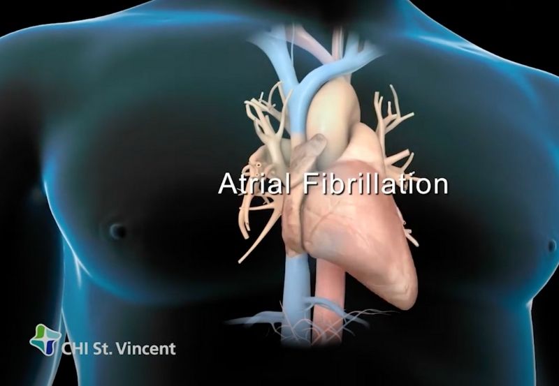 Does Atrial Fibrillation Diagnosis Increase With Age?