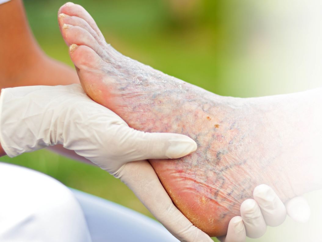 Let’s Talk about Foot Health and Chronic Wounds