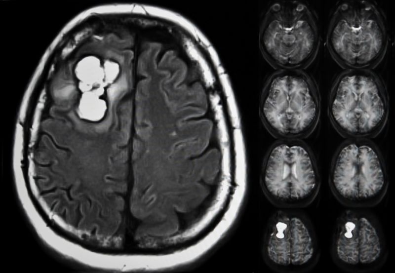 brain tumor x-ray