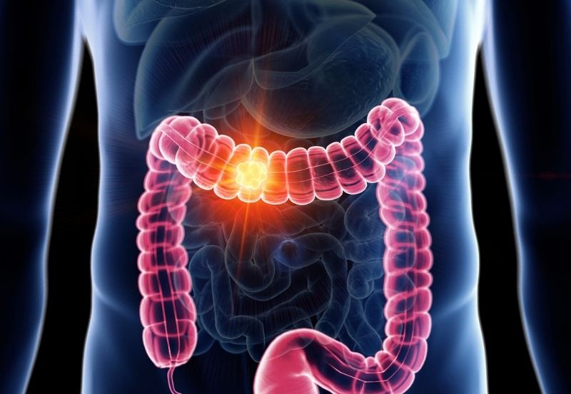 Colonoscopies and Early Detection for Colorectal Cancer