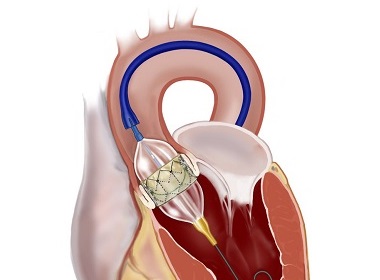TAVR Gives Heart Patients Less Invasive Choice for Treatment