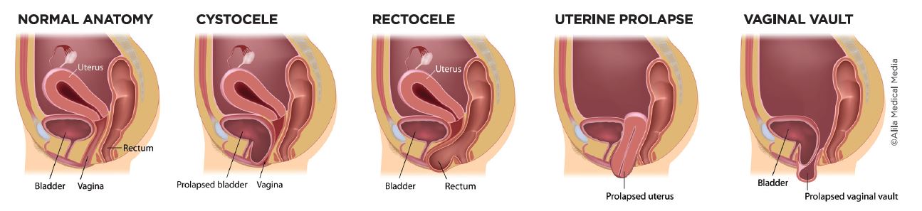 Pelvic Organ Prolapse Comprehensive Services For Women At Chi St Vincent